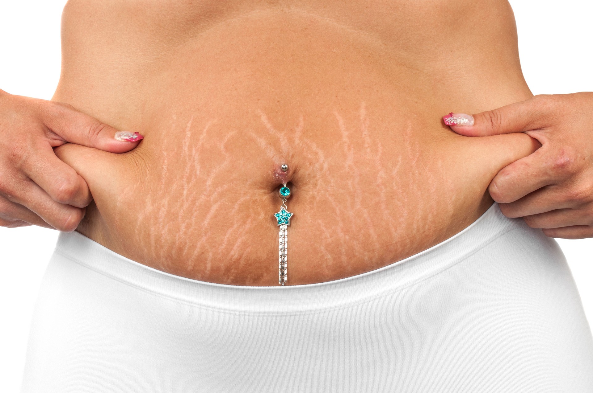 Stretch Mark Camouflage in Bangalorer India Stretch Mark Camouflage in Bangalorer India